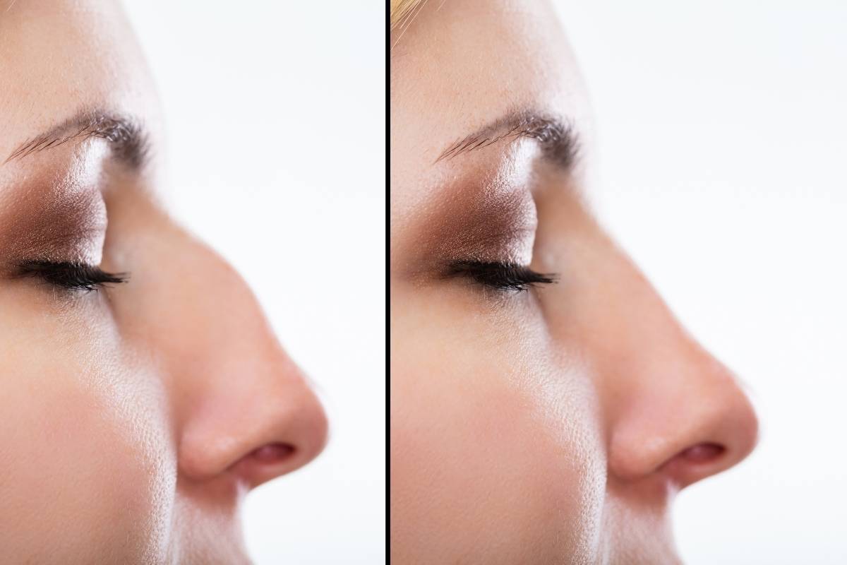 Sun Protection After Rhinoplasty
