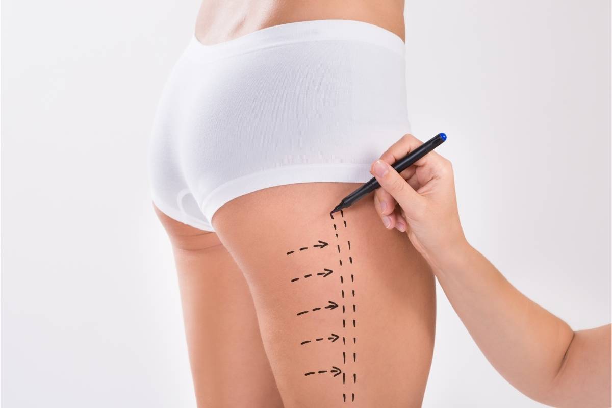  Will My Cellulite Marks Disappear If I Get Outer Thigh Liposuction?