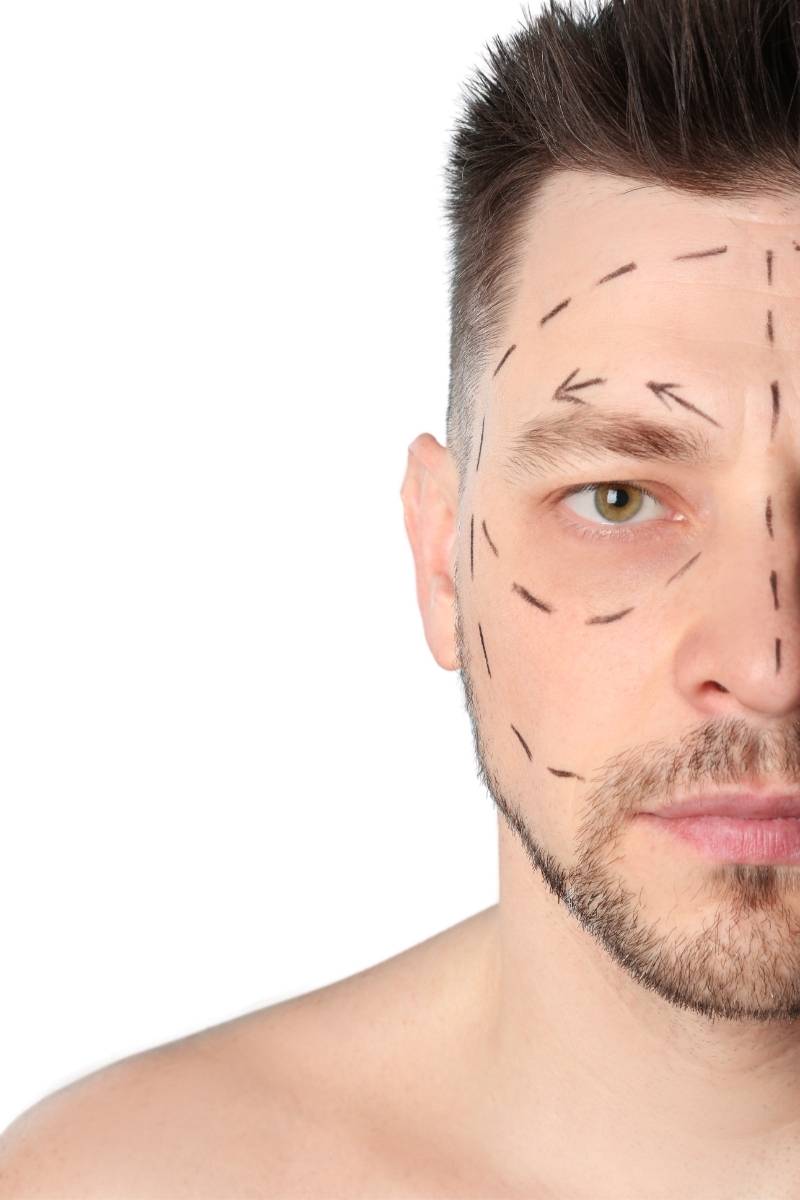 Can Men Have Facelift Surgery?