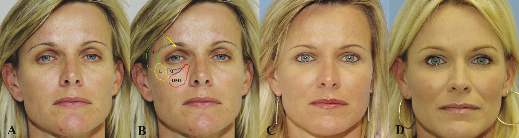 Periorbital Aesthetics: Subtle Refinements That Redefine Facial Expression