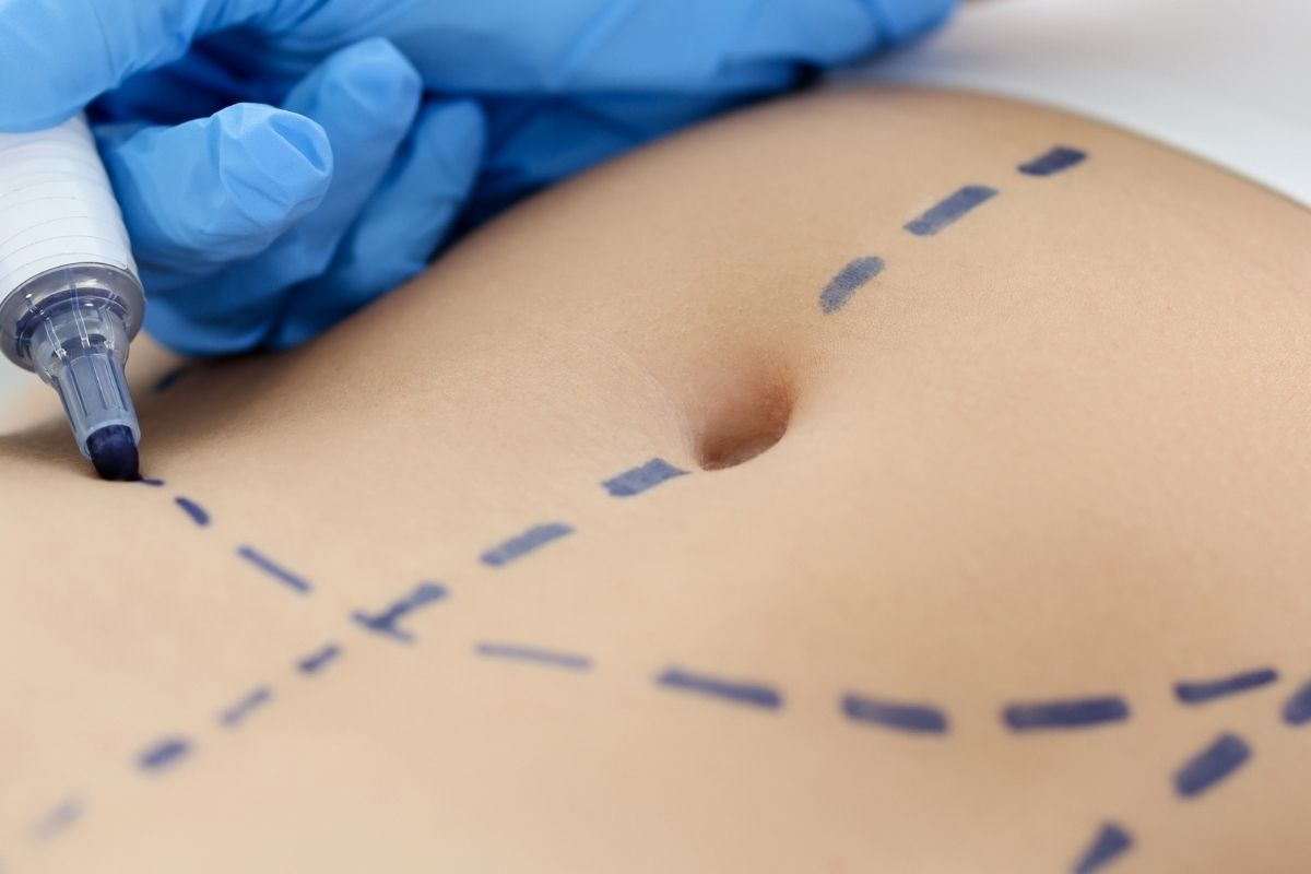 When Can I Wax After Tummy Tuck Surgery?