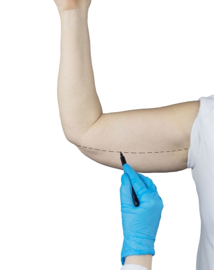 Arm Lift Surgery (Brachioplasty) and Muscle Building After Surgery