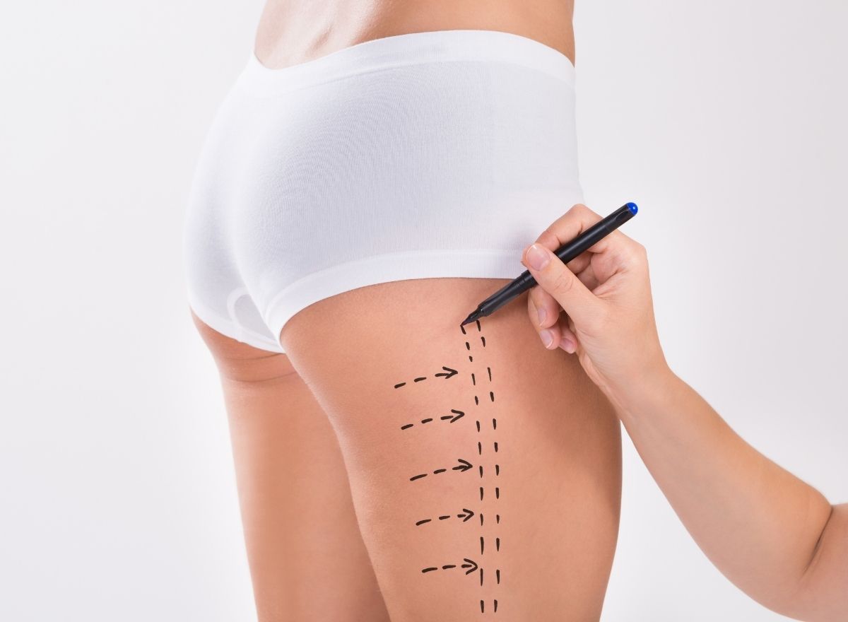 Liposuction Scars: Scarring, Healing Process, and Current Prices in Inner and Outer Thigh Aesthetics