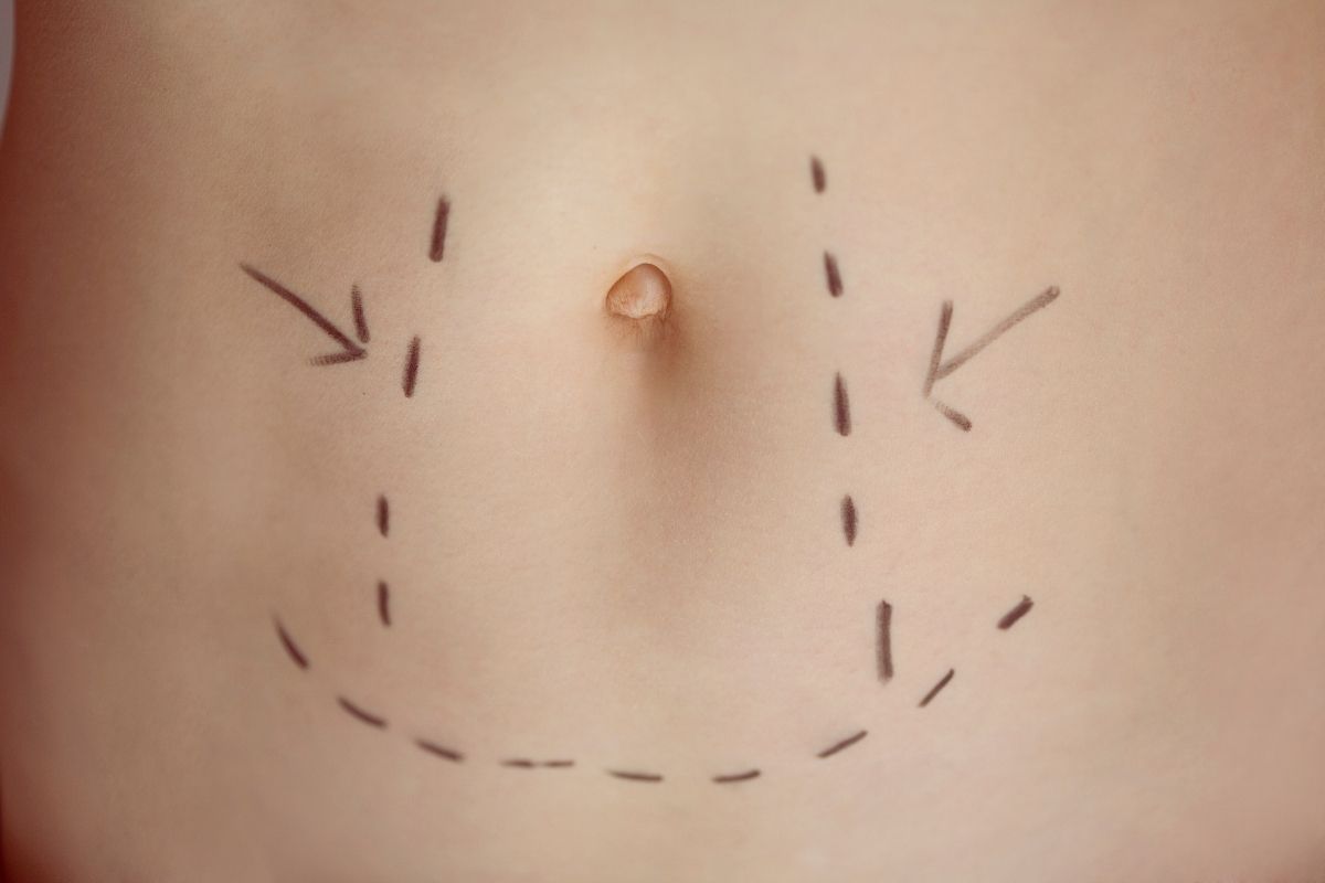 Can Muscular Appearance Be Achieved With Liposuction?