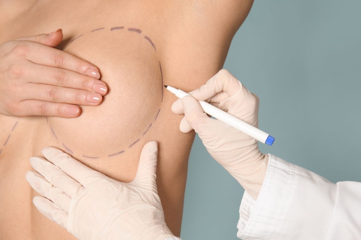 What Is Mammoplasty? A Modern Approach to Breast Aesthetics