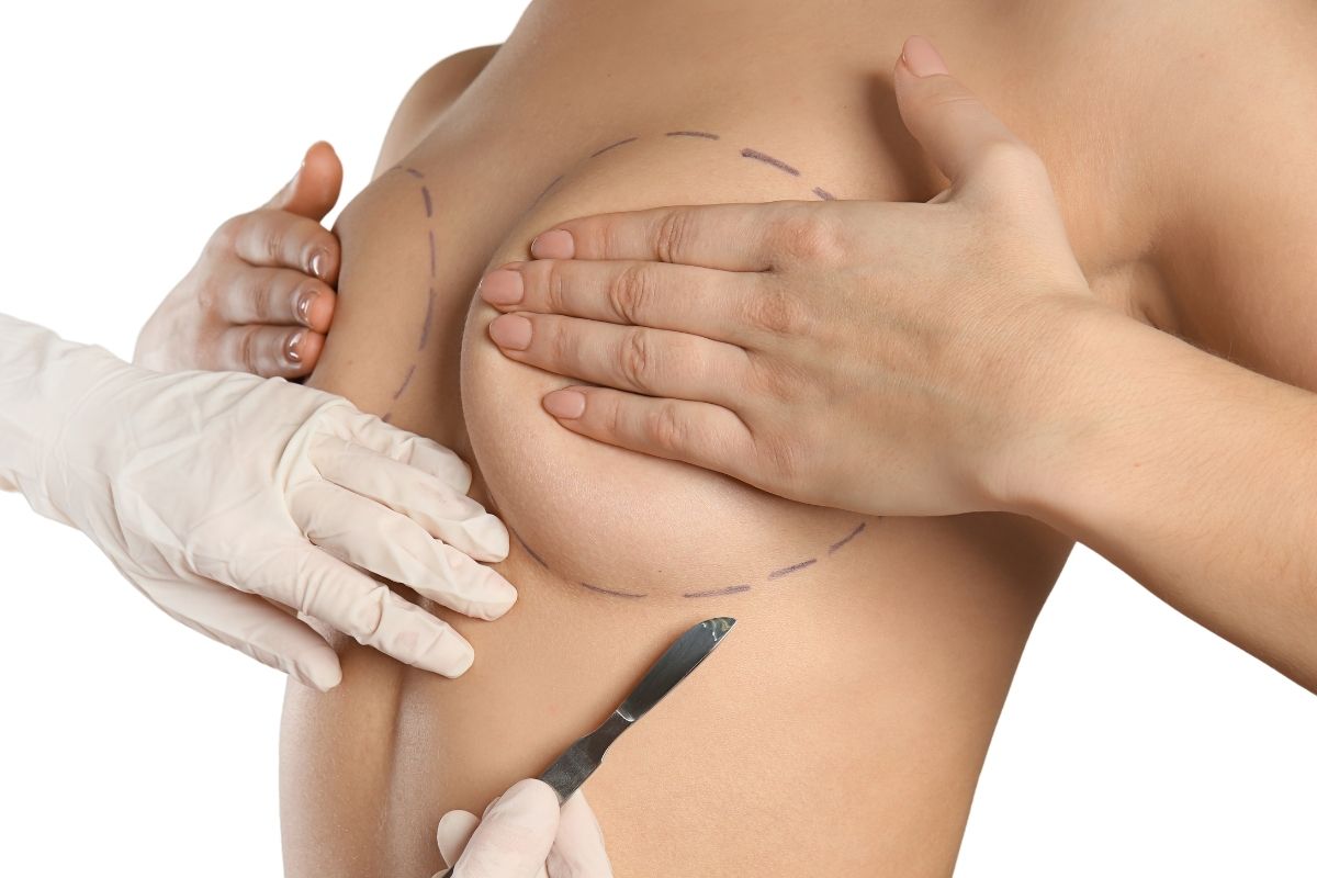 Posture of the Breasts after Breast Reduction Surgery