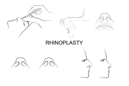 Rhinoplasty (Nose Aesthetics): A Complete Clinical Guide for Patients