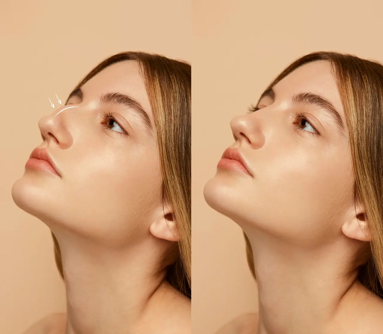 Target in Nose Aesthetics: Naturalness and Comfortable Breathing
